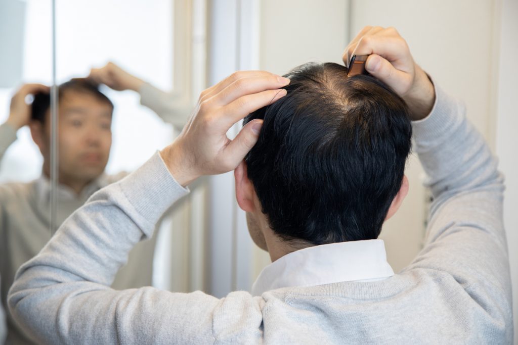 AGA治療薬で本当に薄毛が改善できる？？