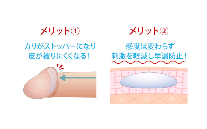 亀頭増大術には包茎改善や早漏防止の効果も