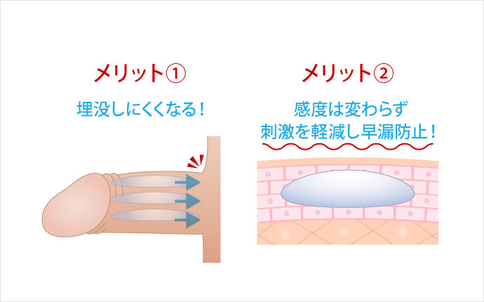 陰茎増大術には埋没しにくくなるメリットや早漏防止の効果も