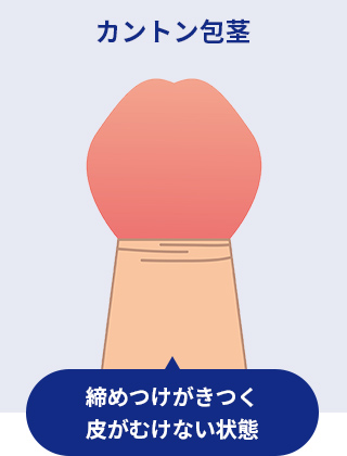 カントン包茎　イメージイラスト