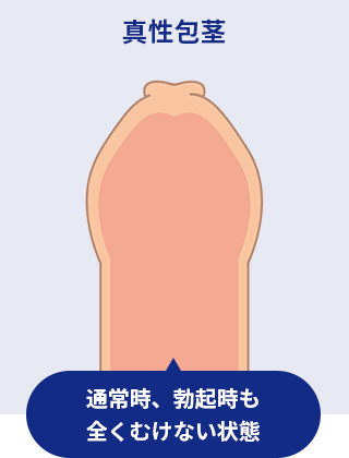 真性包茎　イメージイラスト