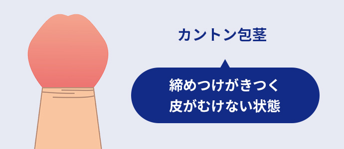 カントン包茎　イメージイラスト
