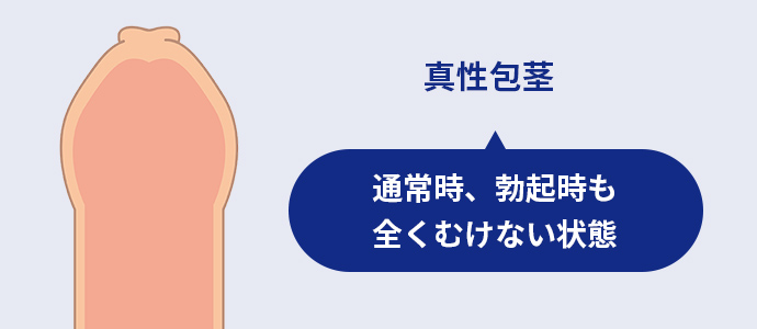 真性包茎　イメージイラスト